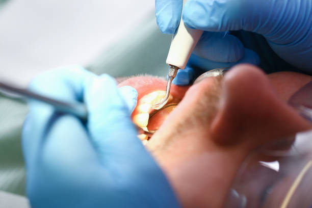Best Emergency Tooth Extraction in Ddleville, MI